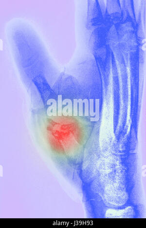 FRACTURED HAND, X-RAY Stock Photo