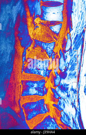 Lumbar Compression Fracture Stock Photo - Alamy