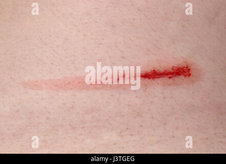 Wound on the skin Stock Photo
