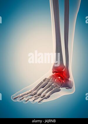 Human ankle pain, illustration Stock Photo - Alamy