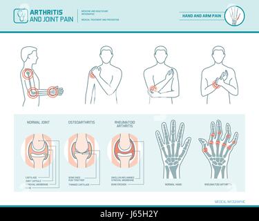 Arthritis and joint pain infographic, anatomic illustration of an inflammed hand and arm Stock Vector