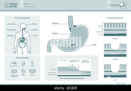 Peptic ulcer and helicobacter pylori infographic with ... helicobacter pylori esophagus diagram 