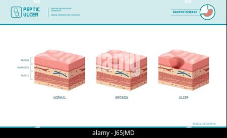 Stomach erosion and peptic ulcer stages infographic: stomach lining and mucosa cross section diagram, medical illustration Stock Vector