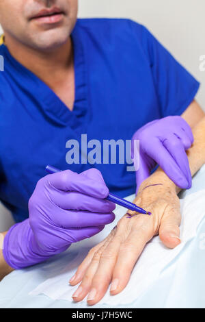A male cosmetic plastic surgeon doctor using a pen marking up the hand of a senior female woman patient in hospital or clinic before surgery Stock Photo