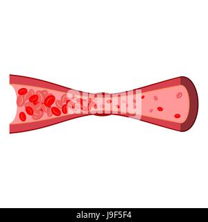 Blood clot in vein isolated. Blood vessel disease on white background. anatomical illustration Stock Vector