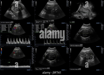 Collage of 9 ultrasonography fetus pictures Stock Photo