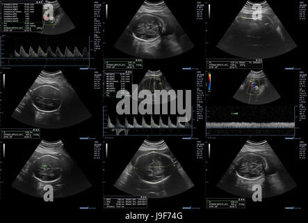 Collage of 9 ultrasonography fetus pictures Stock Photo