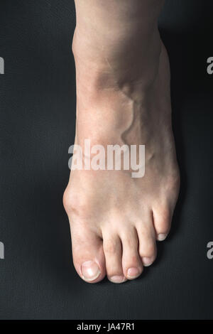 Hallux valgus or bunion on white woman foot Stock Photo