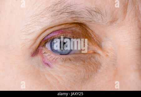Woman's eye injured due to rupture of capillary, causing hematoma or bruising. It could also be conjunctivitis or other allergic eye inflammation Stock Photo