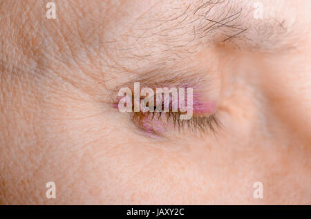 Woman's eye injured due to rupture of capillary, causing hematoma or bruising. It could also be conjunctivitis or other allergic eye inflammation Stock Photo