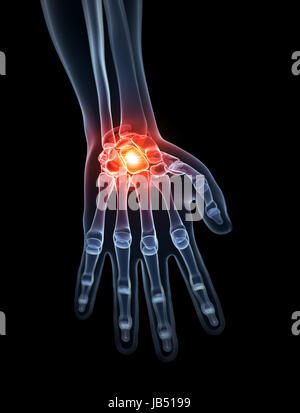 3d rendered illustration - painful wrist Stock Photo