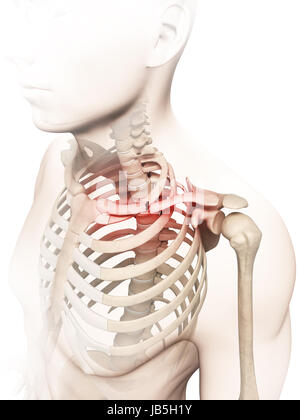 medical illustration of a broken clavicle Stock Photo