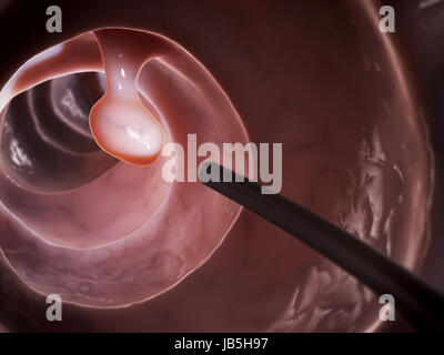 3d rendered illustration of a colonoscopy Stock Photo