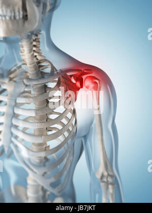 3d rendered illustration of a painful shoulder Stock Photo