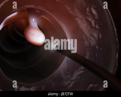 3d rendered illustration of a colonoscopy Stock Photo