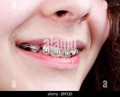 Young woman with brackets on teeth, close up shot Stock Photo