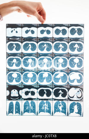 Closeup shot of male hand holding lungs tomography results Stock Photo