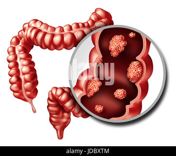 Colon or colorectal cancer concept as a medical illustration of a large intestine with a malignant tumor growth disease of the digestive system. Stock Photo