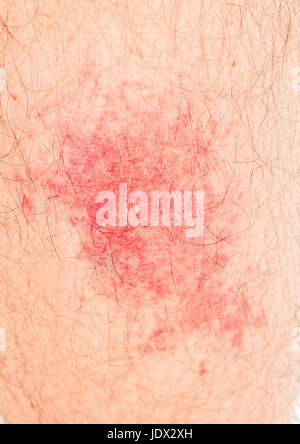 Allergic reaction to insect bite on human skin Stock Photo