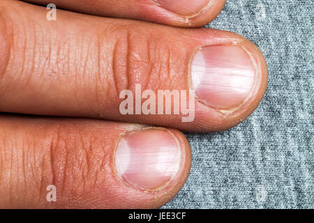 Mens fingers and nails in bad condition close up Stock Photo