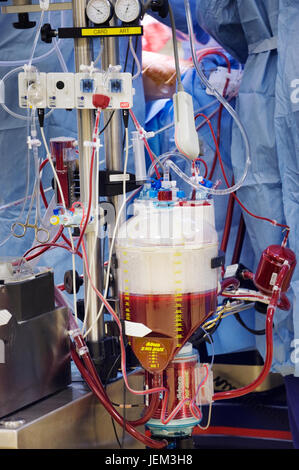 Blood reservoir of perfusion machine which has taken over the heart & lung functions of the patient having Coronary Artery Bypass Graft surgery. Stock Photo