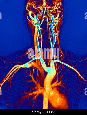Chest, neck and head arteries. Coloured magnetic resonance angiography (MRA) scan of a normal carotid system of a 45 year old female. Bottom centre is the aortic arch, which curves over the heart. The arteries that branch off from these are: the brachiocephalic artery (left), the left common carotid artery (centre) and the left subclavian artery (right). The brachiocephalic artery splits again into the right common carotid and right subclavian arteries. The right and left common carotid arteries supply the neck and the right and left subclavian arteries supply the arms. MRA is a non-invasive Stock Photo