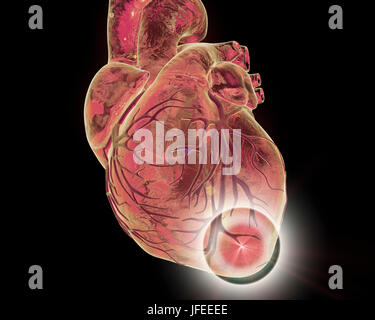 Heart attack, conceptual computer illustration. Stock Photo