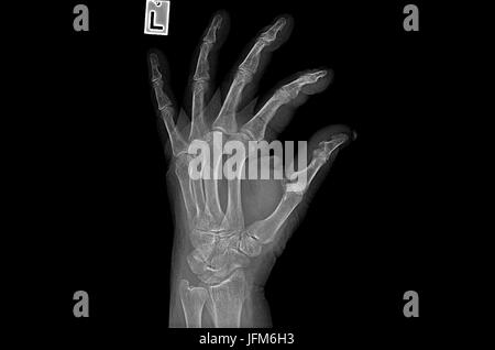 Negative X ray image of human hand Rheumatism Stock Photo