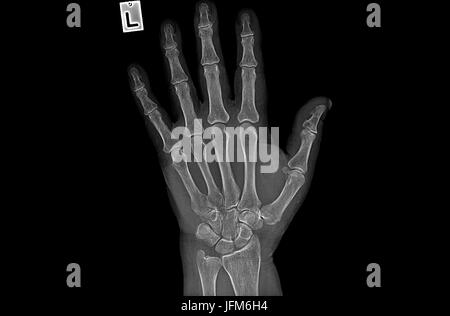 Negative X ray image of human hand Rheumatism Stock Photo