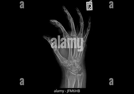 Negative X ray image of human hand Rheumatism Stock Photo