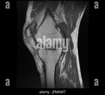 Negative X ray image of human Knee Rheumatism Stock Photo