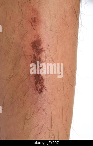 scab