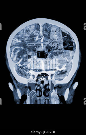 Circuit board in x-ray of skull Stock Photo