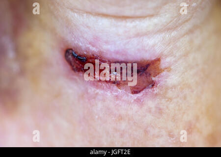 Close up picture of serious injury on elderly female's neck suffering from alzheimer disease Stock Photo