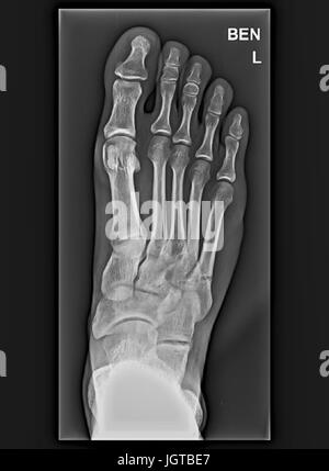 Foot Medical Xray, broken bone, Patient treatment Stock Photo