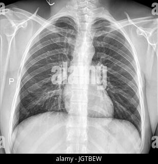 Chest Medical Xray, Lungs and Heart View, Patient treatment Stock Photo