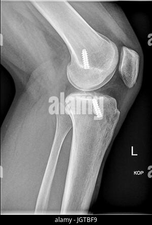 Femoral interference screw, Anatomical reconstruction of anterior cruciate ligament of the knee, medical xray Stock Photo