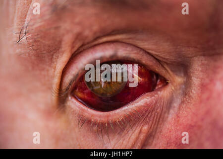 Older male with bloodshot eye Stock Photo