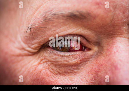 Older male with bloodshot eye Stock Photo