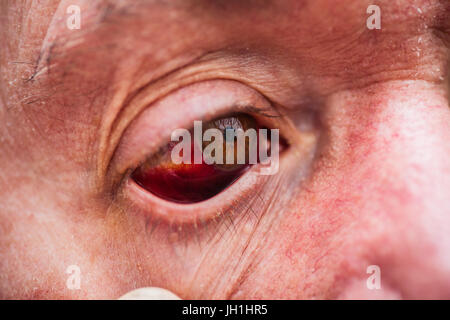 Older male with bloodshot eye Stock Photo