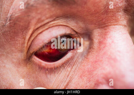 Older male with bloodshot eye Stock Photo