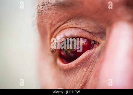 Older male with bloodshot eye Stock Photo