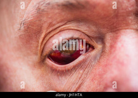 Older male with bloodshot eye Stock Photo