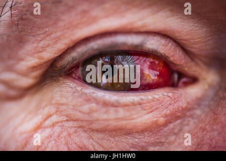 Older male with bloodshot eye Stock Photo