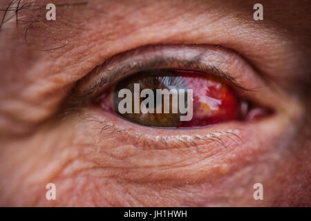 Older male with bloodshot eye Stock Photo