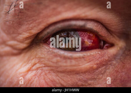 Older male with bloodshot eye Stock Photo