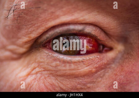 Older male with bloodshot eye Stock Photo