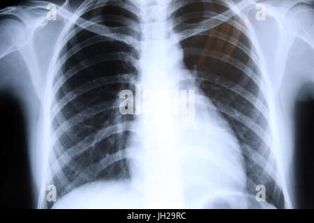Lungs Radiography. X-rays.  Ho Chi Minh City. Vietnam. Stock Photo