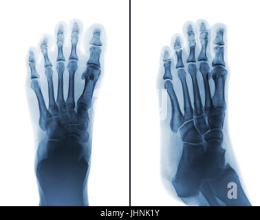 Film x-ray both normal human foots . 2 position ( front view and side view ) Stock Photo