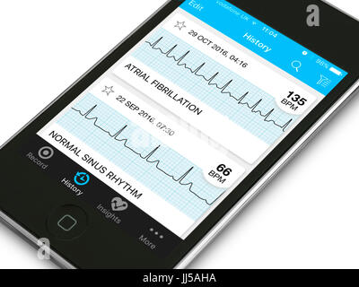 Mobile health and fitness app showing real heart ECG traces for Atrial Fibrillation arrhythmia and Normal Sinus Rhythm on an Apple device. Stock Photo